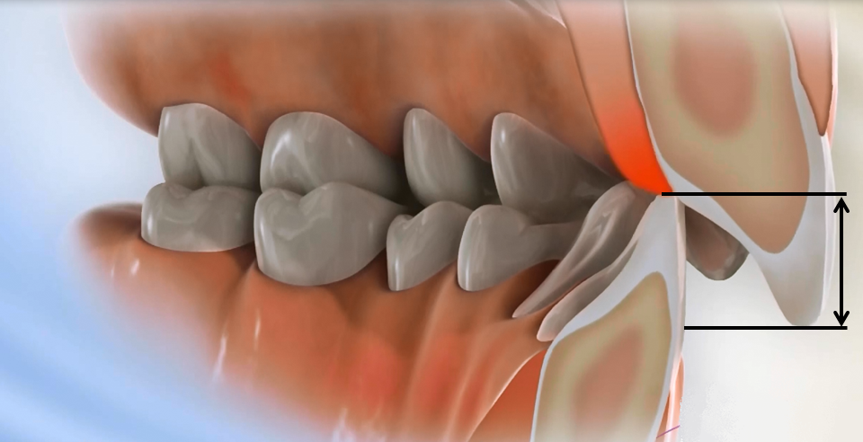 deep bite traumatic